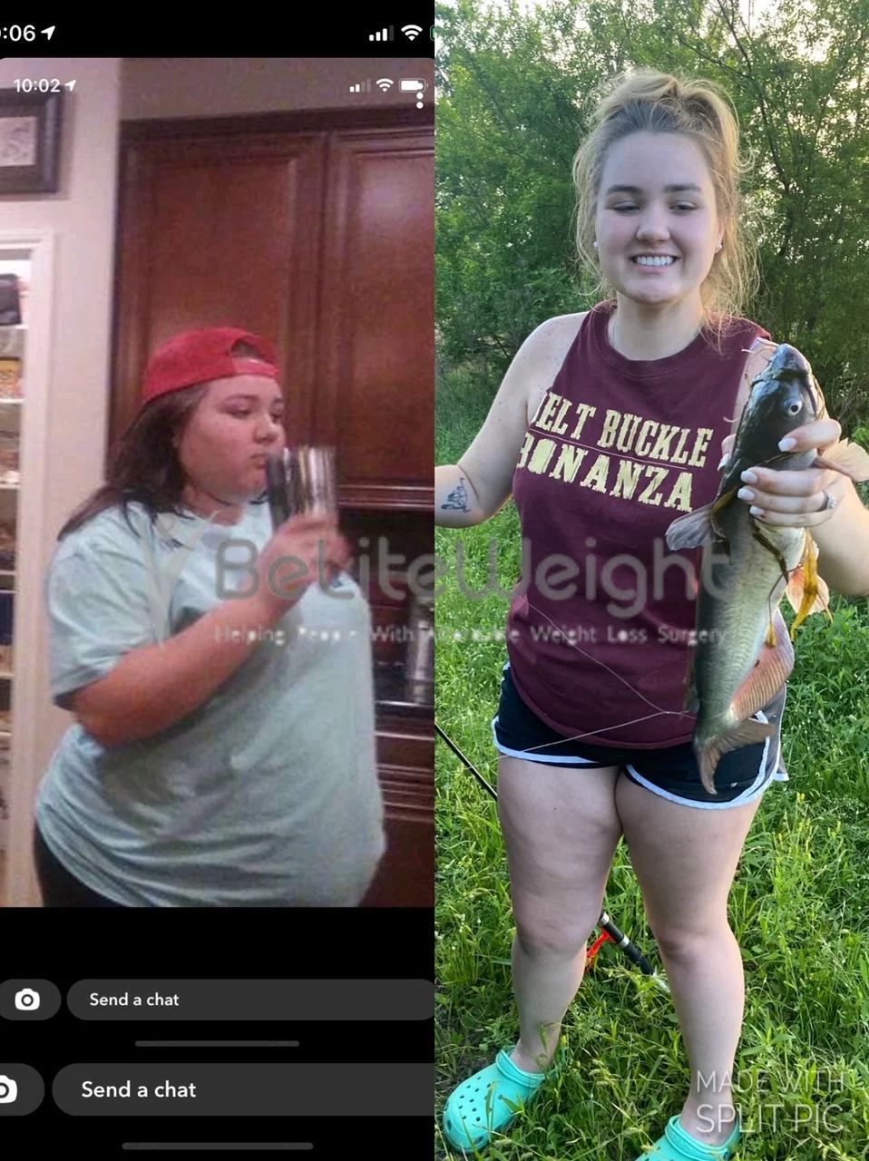 Sleeve Gastrectomy Before and After